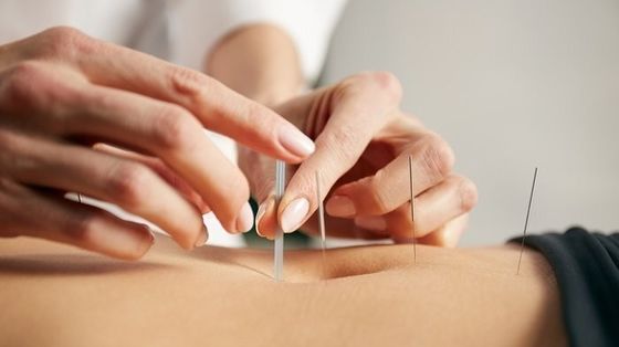 Kosmetische und medizinische intradermale Akupunkturnadeln mit gerader Struktur, die Sicherheit und Wirksamkeit bei der Akupunktur gewährleisten